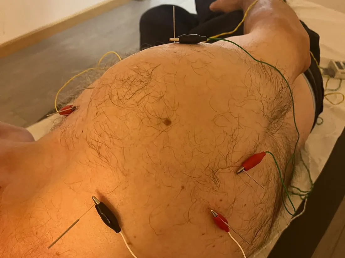 Agullas con electroestimulación no ombreiro durante un tratamento en Acotío Fisioterapia